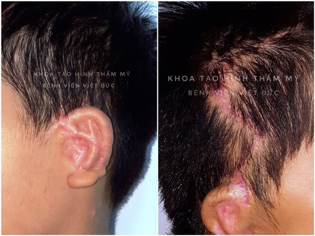 Bác sĩ Việt tự cải tiến kỹ thuật mổ giá siêu rẻ tạo hình tai nhỏ - 1 Bác sĩ Việt tự cải tiến kỹ thuật mổ giá siêu rẻ tạo hình tai nhỏ - 1