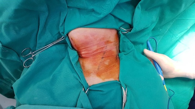 Người phụ nữ nguy kịch, đe doạ máu phun xối xả vì hóc xương cá - 1 Người phụ nữ nguy kịch, đe doạ máu phun xối xả vì hóc xương cá - 1