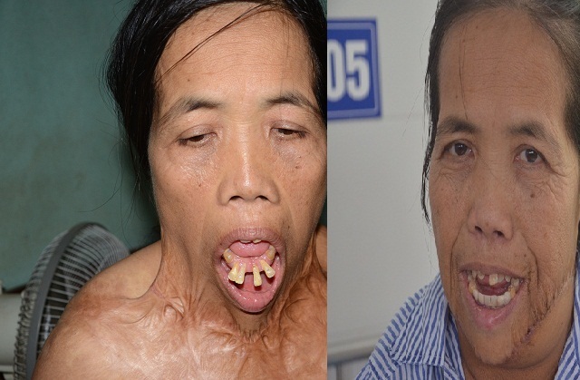 Người đàn bà có hàm răng kì dị lần đầu ngoái cổ sau nửa thế kỉ: Em sợ mẹ không nhận ra - 2 Người đàn bà có hàm răng kì dị lần đầu ngoái cổ sau nửa thế kỉ: Em sợ mẹ không nhận ra - 2