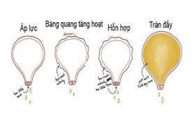Ích Tiểu Vương - Giải pháp tối ưu giúp cải thiện bàng quang kích thích - 1 Ích Tiểu Vương - Giải pháp tối ưu giúp cải thiện bàng quang kích thích - 1