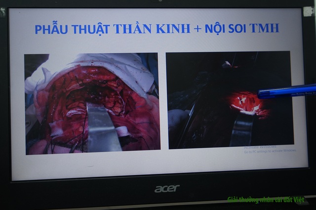 BV Chợ Rẫy: Phương pháp phẫu thuật 3 trong 1 giúp người bệnh thoát “án tử” - 7 BV Chợ Rẫy: Phương pháp phẫu thuật 3 trong 1 giúp người bệnh thoát “án tử” - 7