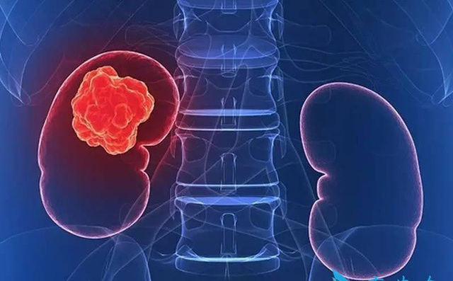 13 dấu hiệu trên cơ thể cảnh báo ung thư thận ngầm phát triển mạnh mẽ - 1 13 dấu hiệu trên cơ thể cảnh báo ung thư thận ngầm phát triển mạnh mẽ - 1
