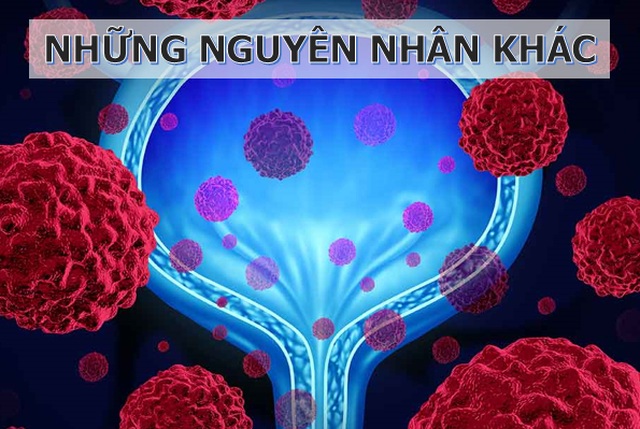 Nguy cơ mắc ung thư bàng quang từ chính nơi làm việc của bạn - 3 Nguy cơ mắc ung thư bàng quang từ chính nơi làm việc của bạn - 3