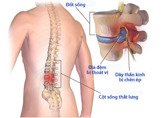 Cải thiện thoát vị đĩa đệm đốt sống lưng nhờ Cốt Thoái Vương - 1 Cải thiện thoát vị đĩa đệm đốt sống lưng nhờ Cốt Thoái Vương - 1