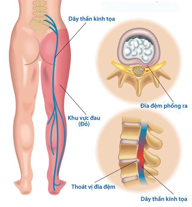 Cải thiện thoát vị đĩa đệm đốt sống lưng nhờ Cốt Thoái Vương - 2 Cải thiện thoát vị đĩa đệm đốt sống lưng nhờ Cốt Thoái Vương - 2