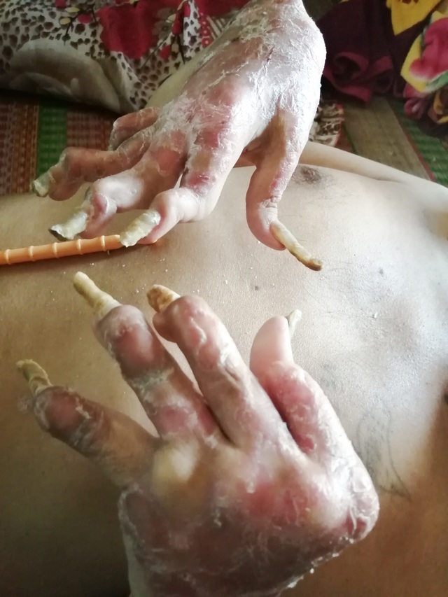 Sởn da gà cảnh người đàn ông vạm vỡ bị bệnh vảy nến quật ngã có bộ da như da cá sấu - 1 Sởn da gà cảnh người đàn ông vạm vỡ bị bệnh vảy nến quật ngã có bộ da như da cá sấu - 1