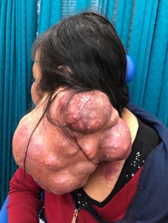 U lành hóa thành bướu ác vì chậm trễ điều trị - 1 U lành hóa thành bướu ác vì chậm trễ điều trị - 1
