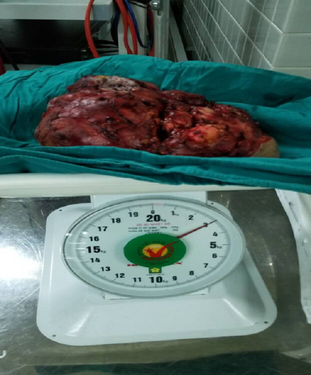 U lành hóa thành bướu ác vì chậm trễ điều trị - 2 U lành hóa thành bướu ác vì chậm trễ điều trị - 2
