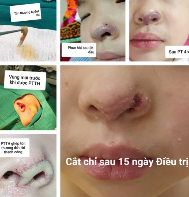 Tìm thấy phần mũi bị đứt rời của bé gái 5 tuổi trong thùng rác - 1 Tìm thấy phần mũi bị đứt rời của bé gái 5 tuổi trong thùng rác - 1