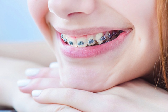 Nên hay không nên cho con niềng răng? - 1 Nên hay không nên cho con niềng răng? - 1