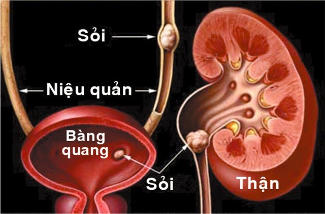 Đả Thạch Vương - Hỗ trợ hiệu quả cho người mắc sỏi tiết niệu, sỏi mật - 1 Đả Thạch Vương - Hỗ trợ hiệu quả cho người mắc sỏi tiết niệu, sỏi mật - 1