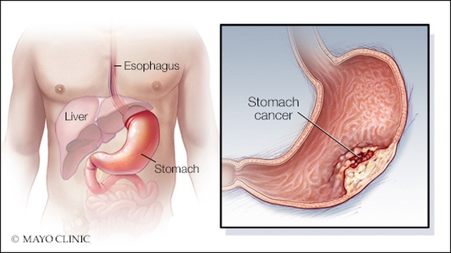 Ung thư dạ dày: Dấu hiệu nhận biết và cách phòng ngừa - 1