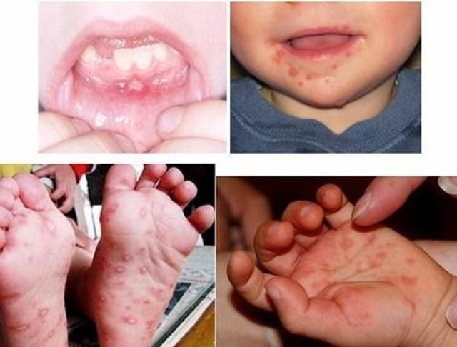 Bệnh tay chân miệng ở trẻ nhỏ và giải pháp độc đáo từ bộ đôi sản phẩm Subạc - 2