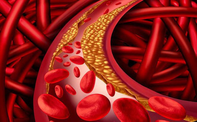 Cải thiện triệu chứng rối loạn lipid máu hiệu quả, an toàn nhờ Lipidcleanz - 1 Cải thiện triệu chứng rối loạn lipid máu hiệu quả, an toàn nhờ Lipidcleanz - 1