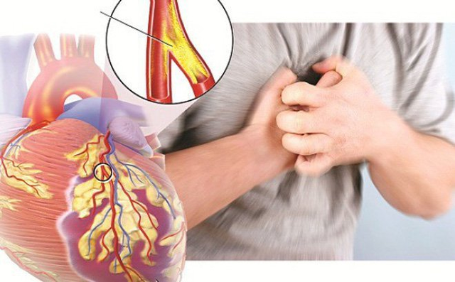 Cải thiện triệu chứng rối loạn lipid máu hiệu quả, an toàn nhờ Lipidcleanz - 2 Cải thiện triệu chứng rối loạn lipid máu hiệu quả, an toàn nhờ Lipidcleanz - 2