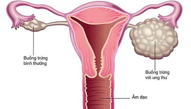 Nhiều trẻ mới hơn 10 tuổi đã bị ung thư buồng trứng - 1 Nhiều trẻ mới hơn 10 tuổi đã bị ung thư buồng trứng - 1