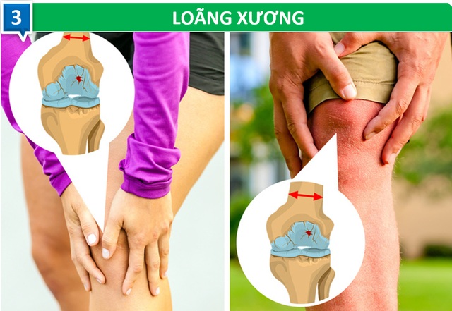 “Kỳ lạ” những vấn đề sức khỏe ảnh hưởng đàn ông và phụ nữ theo cách khác biệt - 3 “Kỳ lạ” những vấn đề sức khỏe ảnh hưởng đàn ông và phụ nữ theo cách khác biệt - 3