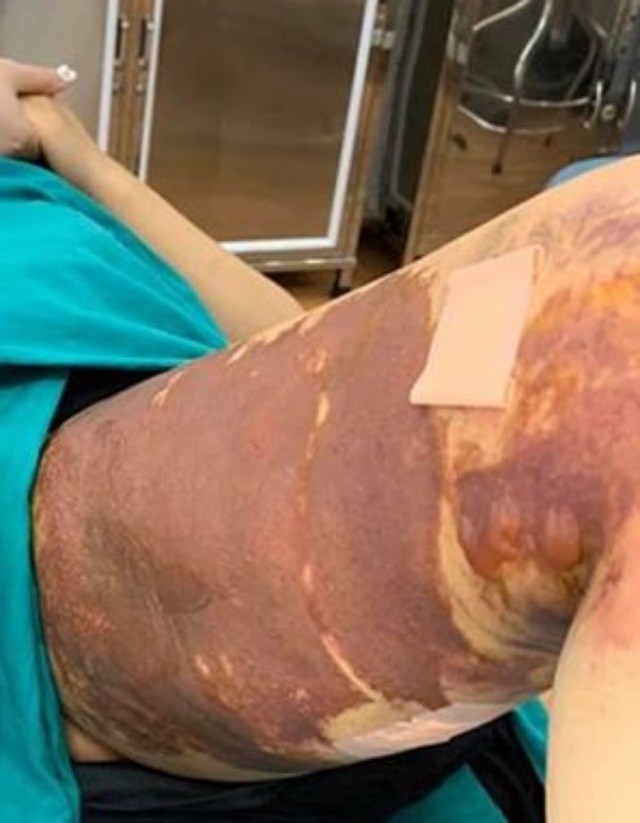 Thêm nạn nhân của Thẩm mỹ viện Việt Hàn bỏng nặng sau hút mỡ - 1