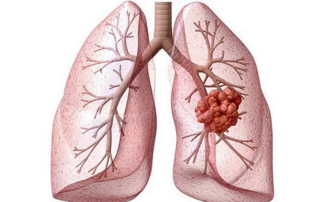 Phát hiện mới: Kết hợp Đông-Tây y trong điều trị ung thư mang lại kết quả vượt trội - 1 Phát hiện mới: Kết hợp Đông-Tây y trong điều trị ung thư mang lại kết quả vượt trội - 1