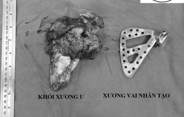 Đau vai suốt 5 năm, cô giáo tiểu học sốc khi phát hiện bị ung thư xương - 2 Đau vai suốt 5 năm, cô giáo tiểu học sốc khi phát hiện bị ung thư xương - 2