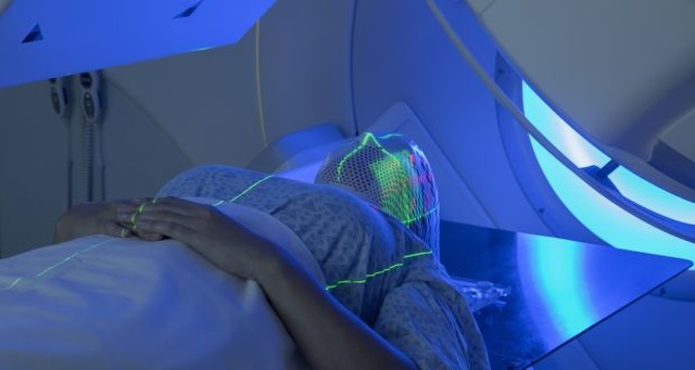 Xạ trị gây nên những tác dụng phụ gì? - 1 Xạ trị gây nên những tác dụng phụ gì? - 1