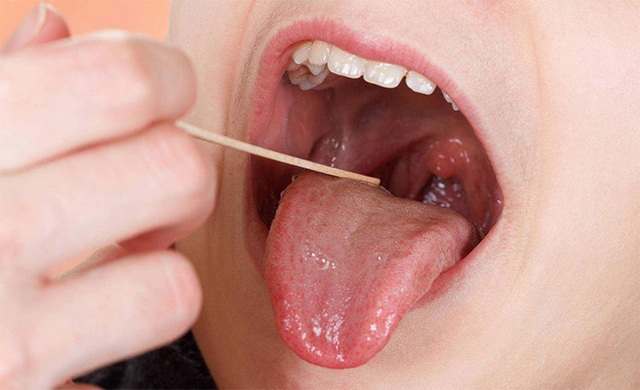 Ung thư lưỡi ngày càng phổ biến, bác sĩ cảnh báo 4 nguyên nhân gây bệnh - 1 Ung thư lưỡi ngày càng phổ biến, bác sĩ cảnh báo 4 nguyên nhân gây bệnh - 1