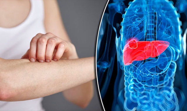Sút cân, mệt mỏi có phải đã mắc ung thư gan? - 1 Sút cân, mệt mỏi có phải đã mắc ung thư gan? - 1