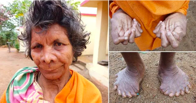 Gặp người phụ nữ có 31 ngón tay chân, được lưu danh vào kỷ lục Guinness