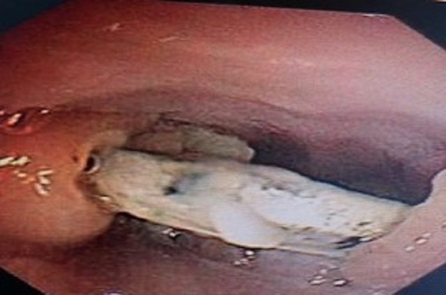 Xương gà xuyên thủng thực quản, bác sĩ chẩn đoán ngộ độc thực phẩm - 2