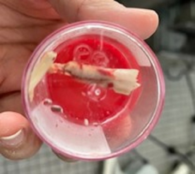 Xương gà xuyên thủng thực quản, bác sĩ chẩn đoán ngộ độc thực phẩm - 3