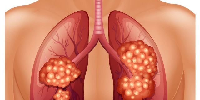 Ung thư phổi thường bộc lộ triệu chứng khi đã di căn xa - 1