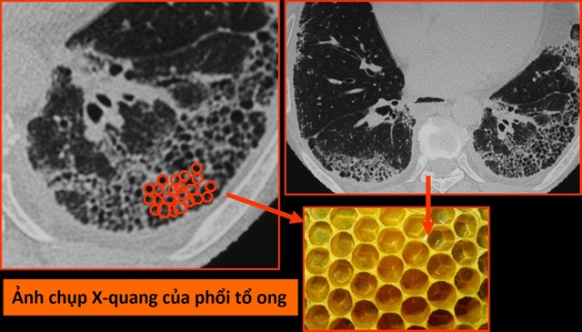 Virus corona mới tàn phá các bộ phận trên cơ thể như thế nào? - 3