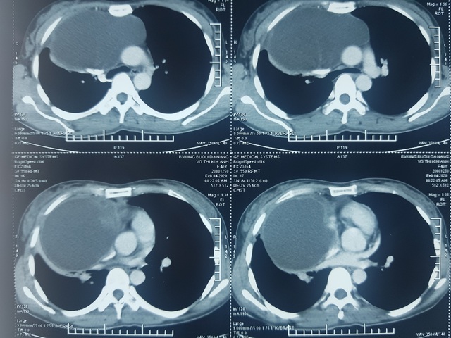 Mổ lấy thành công khối u lớn chèn ép tim, phổi nữ bệnh nhân - 1