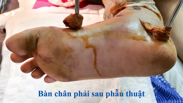 Chạy đua với thời gian cứu sống bàn chân bé gái - 2