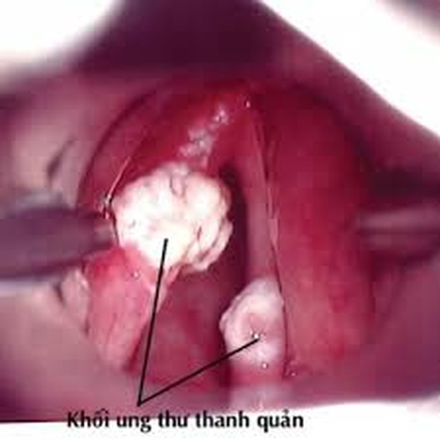 Ung thư thanh quản - 1 Ung thư thanh quản - 1