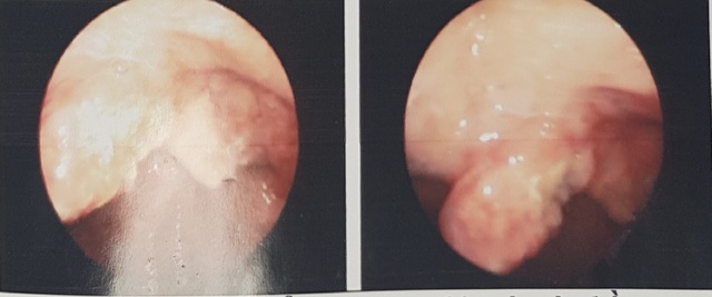 Tưởng sùi mào gà miệng hóa mắc bệnh ung thư hiếm - 1