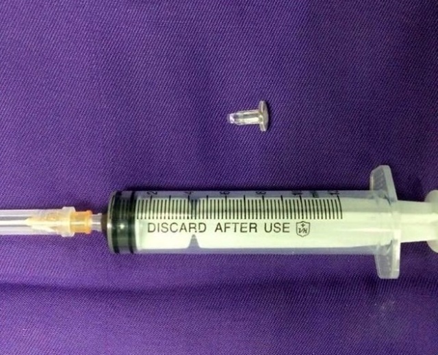 Bé 9 tuổi tím tái vì đầu bút bi gây bít tắc phế quản - 2 Bé 9 tuổi tím tái vì đầu bút bi gây bít tắc phế quản - 2