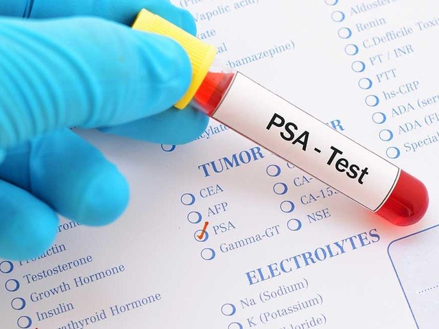 Chỉ số PSA và những cảnh báo nguy cơ ung thư tiền liệt tuyến - 1