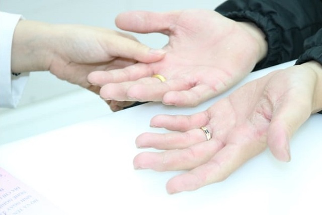 Nhiều người tổn thương da vì thường xuyên sát khuẩn phòng Covid-19 - 2 Nhiều người tổn thương da vì thường xuyên sát khuẩn phòng Covid-19 - 2