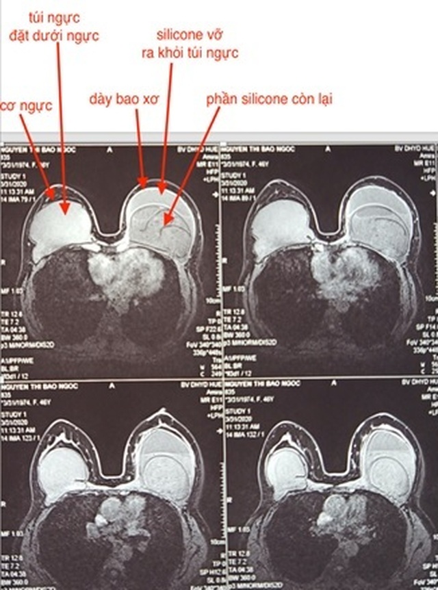 Vỡ túi ngực là hiện tượng gì?
