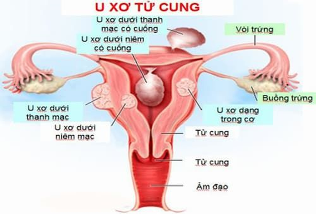 Ago Tumor giải pháp mới, hỗ trợ giảm triệu chứng u xơ tử cung, u vú lành tính - 2