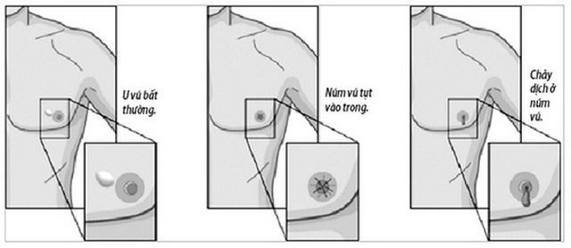 Các dấu hiệu báo động ung thư vú ở nam giới - 1 Các dấu hiệu báo động ung thư vú ở nam giới - 1