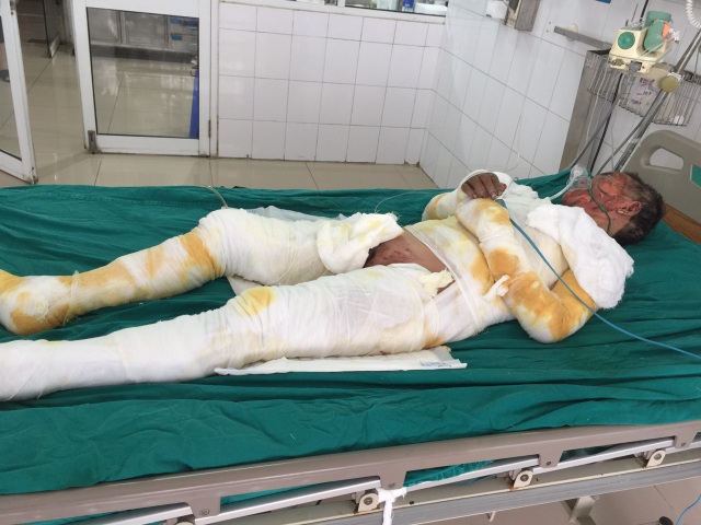 Ba người trong gia đình bị lửa thiêu nguy kịch cầu mong nhà hảo tâm giúp đỡ - 2