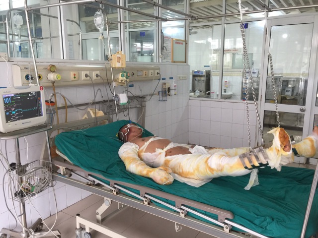 Ba người trong gia đình bị lửa thiêu nguy kịch cầu mong nhà hảo tâm giúp đỡ - 1