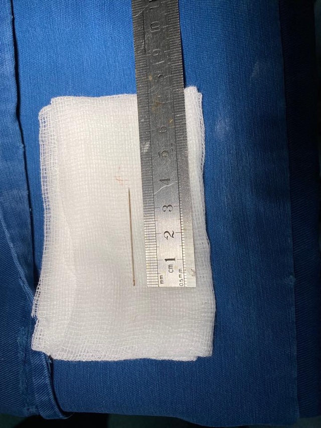 Gắp thành công kim đâm xuyên thành ngực cứu bệnh nhi 3 tuổi - 2 Gắp thành công kim đâm xuyên thành ngực cứu bệnh nhi 3 tuổi - 2