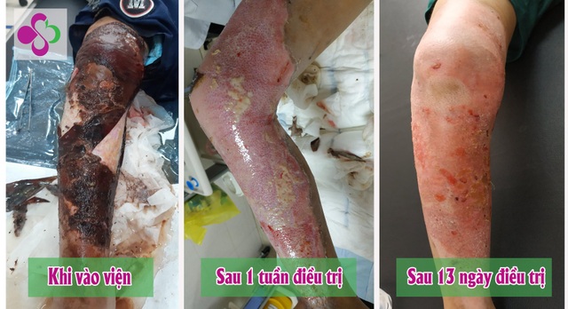 Dùng thuốc đỏ sát trùng vết bỏng, bé trai 7 tuổi hoại tử vùng đùi - 1 Dùng thuốc đỏ sát trùng vết bỏng, bé trai 7 tuổi hoại tử vùng đùi - 1