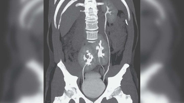 Phát hiện có tới 3… quả thận khi đi khám đau lưng - 1 Phát hiện có tới 3… quả thận khi đi khám đau lưng - 1