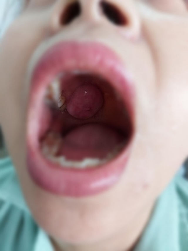 Sau 3 năm, khối u trong khoang miệng hóa ung thư ăn mòn xương - 1 Sau 3 năm, khối u trong khoang miệng hóa ung thư ăn mòn xương - 1