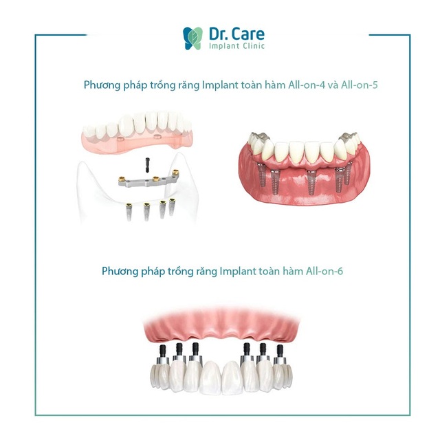 Loại bỏ nỗi lo chi phí với phương pháp trồng răng Implant toàn hàm tiết kiệm - 1 Loại bỏ nỗi lo chi phí với phương pháp trồng răng Implant toàn hàm tiết kiệm - 1