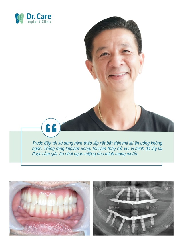 Loại bỏ nỗi lo chi phí với phương pháp trồng răng Implant toàn hàm tiết kiệm - 2 Loại bỏ nỗi lo chi phí với phương pháp trồng răng Implant toàn hàm tiết kiệm - 2